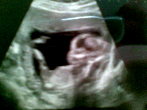 Dionne Scan (16 Weekd old)